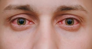 علاج رمد العين