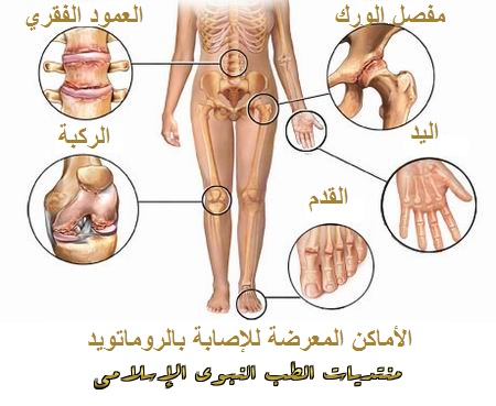 علاج الروماتويد بالحجامة 2100 1