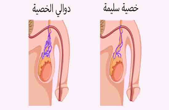 اعراض دوالي الخصية اليسرى 1790 1