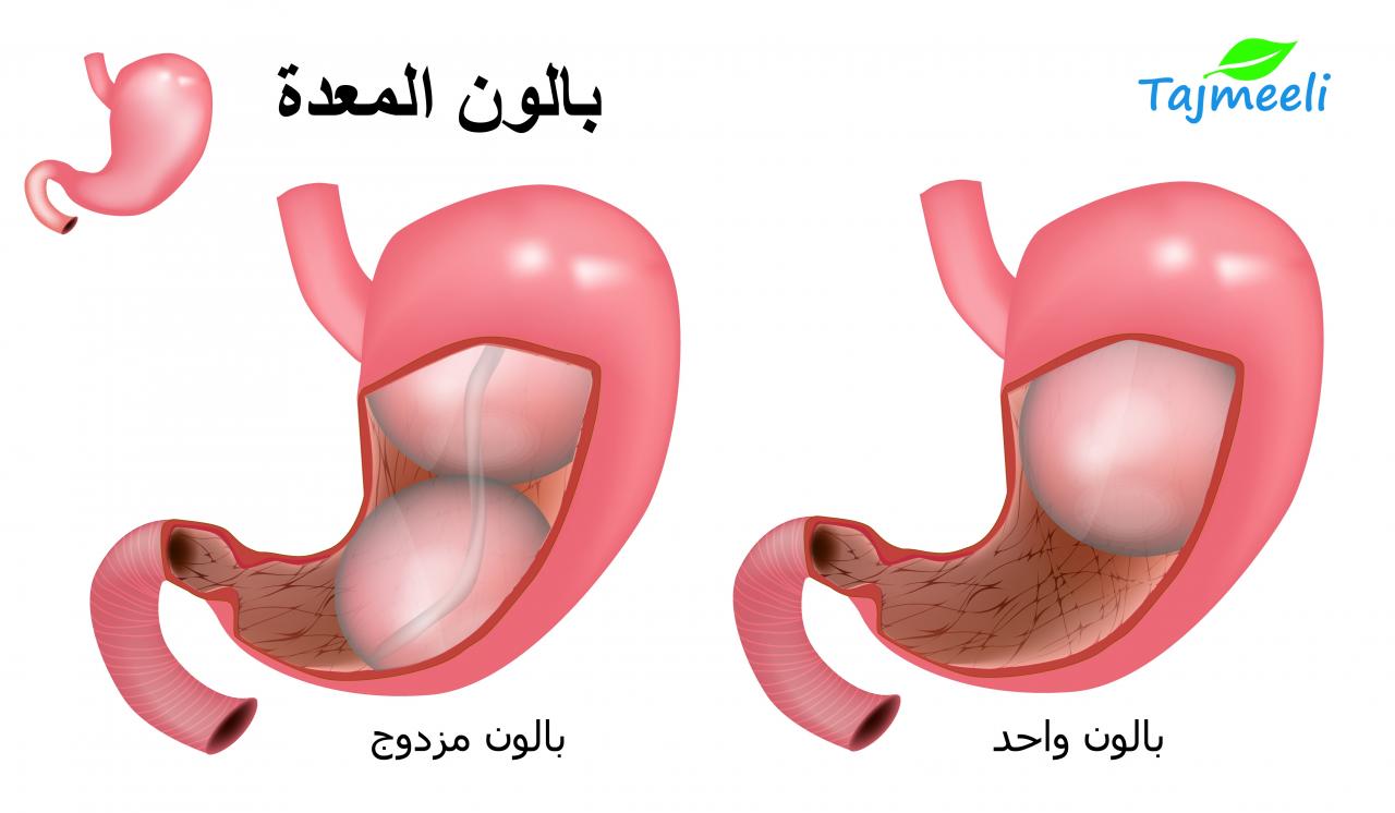 اضرار بالون المعدة